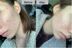 Androgen Blocker Plus for PCOS 17 Image Placeholders